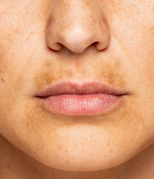 Melasma vs Sunspots