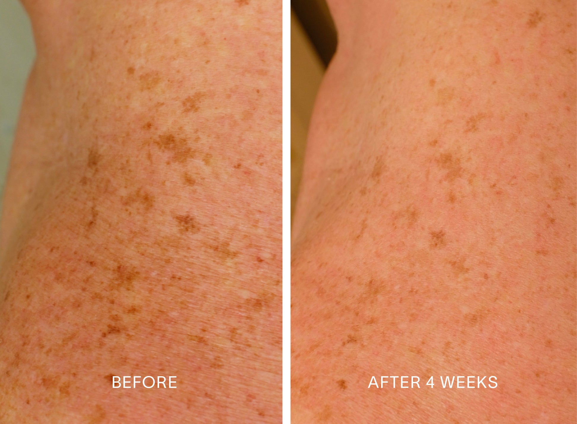 Doctor Rogers Body Duo | Featuring the Body Repair Treatment to smooth crepey skin, soften wrinkles, and even tone. Also includes Body Cream to deeply hydrate and strengthens the skin barrier using the highest-quality humectants, emollients, and ceramides.  
Picture featuring before and after results of women who used Doctor Rogers Body Duo in a 4 week clinical study with visibly less wrinkles and dark spots on chest. 
Safe for men and women wtih all skin types including sensitive, mature, aging skin.
