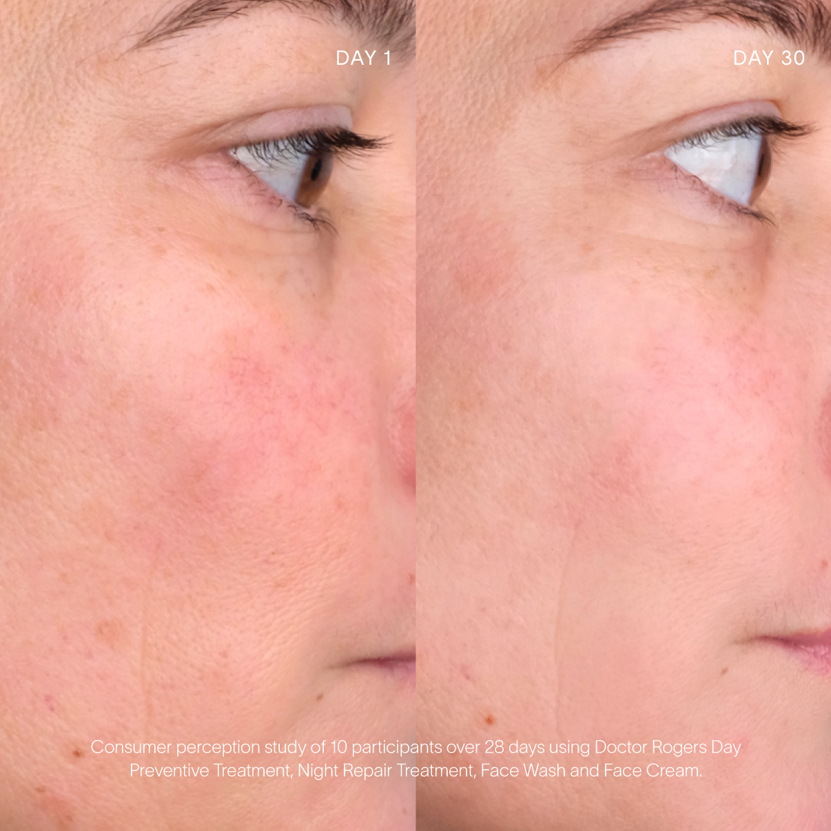 Middle Aged women displaying skin care results including reduce redness and inflammation on right cheek after using Doctor Rogers Day Preventive Treatment, Night Repair Treatement, Face Wash and Face Cream for 28 days in a consumer perception study