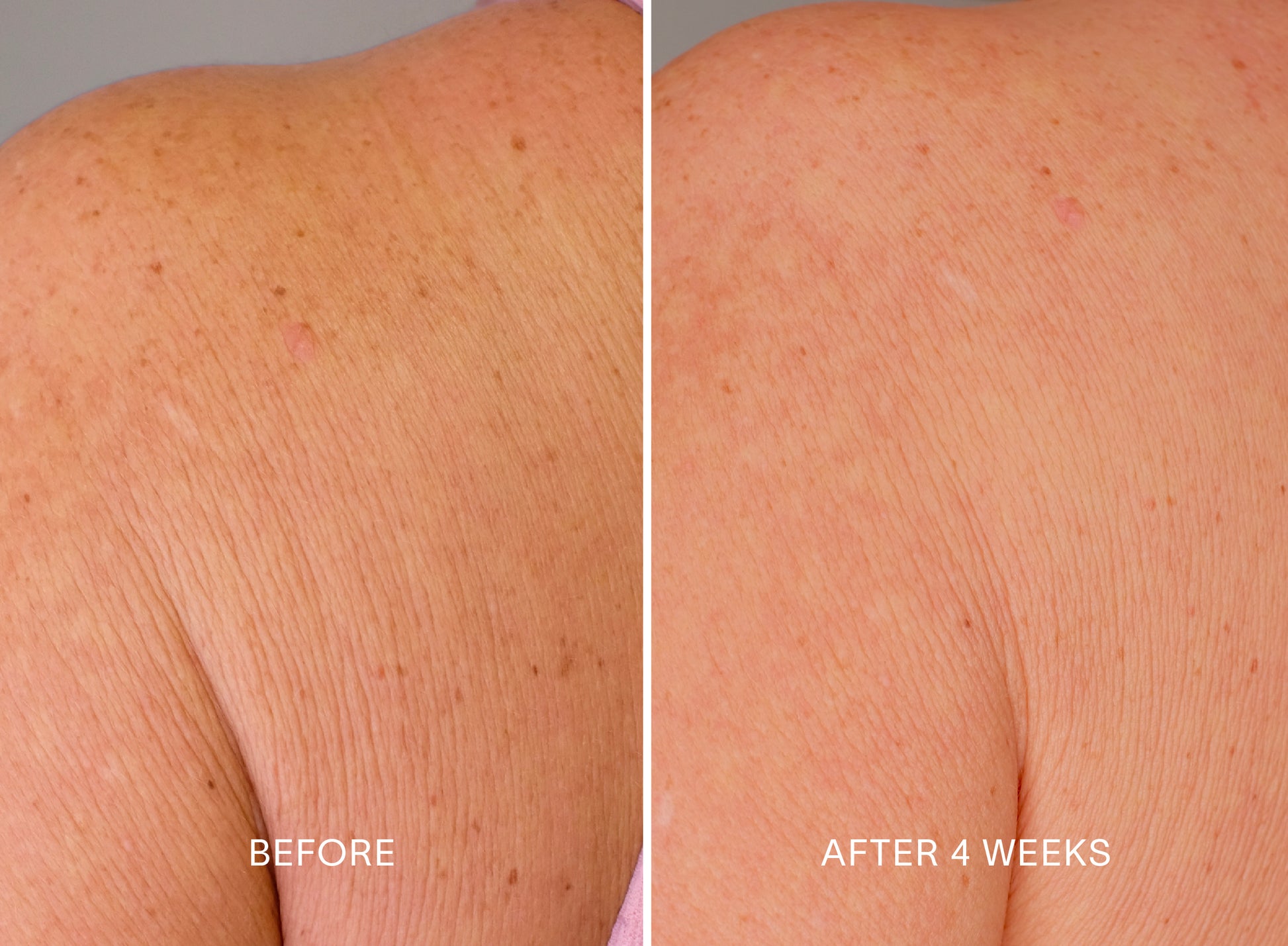 Doctor Rogers Body Duo | Featuring the Body Repair Treatment to smooth crepey skin, soften wrinkles, and even tone. Also includes Body Cream to deeply hydrate and strengthens the skin barrier using the highest-quality humectants, emollients, and ceramides.  
Picture featuring before and after results of women who used Doctor Rogers Body Duo in a 4 week clinical study with visibly less wrinkles on back/shoulders.
Safe for men and women wtih all skin types including sensitive, mature, aging skin.