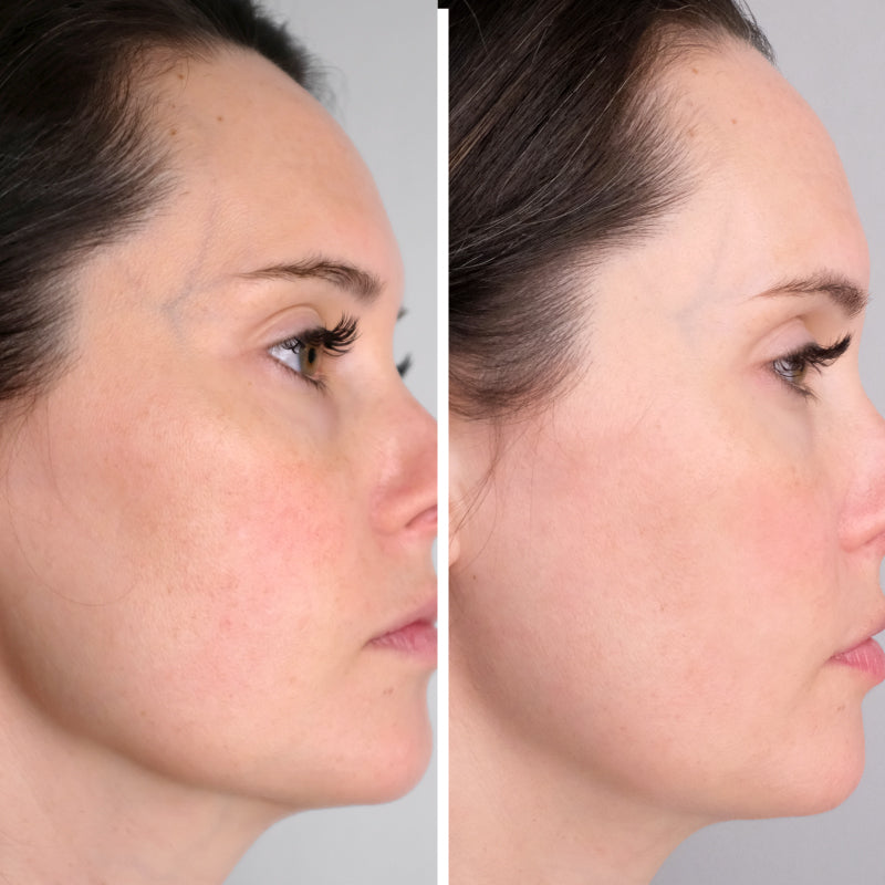 Middle aged woman before (left) and after (right) photos using Doctor Rogers Advance Duo | Day Preventive Treatment Serum to protect skin against sun damage with antioxidants and vitamin B,C and E and Night Repair Treatment to fight wrinkles and smooth fine lines on all dry, sensitive, oily skin.