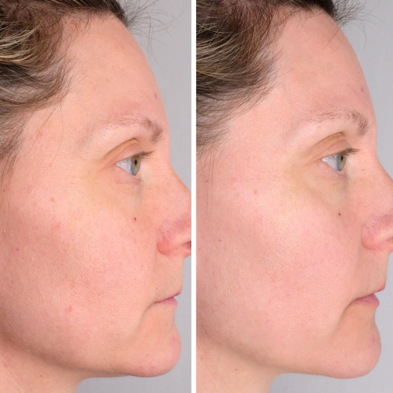 Woman age 20 - 40  before (left) and after (right) photos using Doctor Rogers Night Repair Treatment | A gentle retinol alternative for sensitive skin made to fight wrinkles, smooth fine lines and stimulate skin renewal