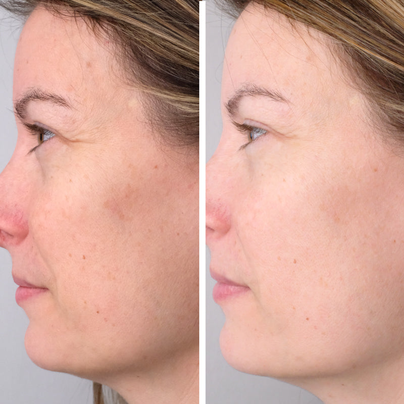Woman age 20 - 40 before (left) and after (right) photos using Doctor Rogers Night Repair Treatment | A gentle retinol alternative for sensitive skin made to fight wrinkles, even skin tone, smooth fine lines and stimulate skin renewal