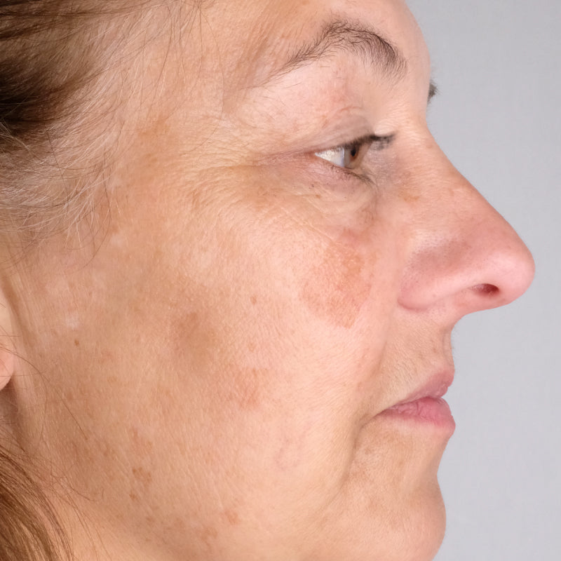 Woman age 35 - 50 who participated in Doctor Rogers Advance Duo Treatment Study displaying side profile of face after using Doctor Rogers Day Preventive Treatment and Night Repair Treatment displaying improved skin tone, reduced wrinkles and minimized fine lines.
