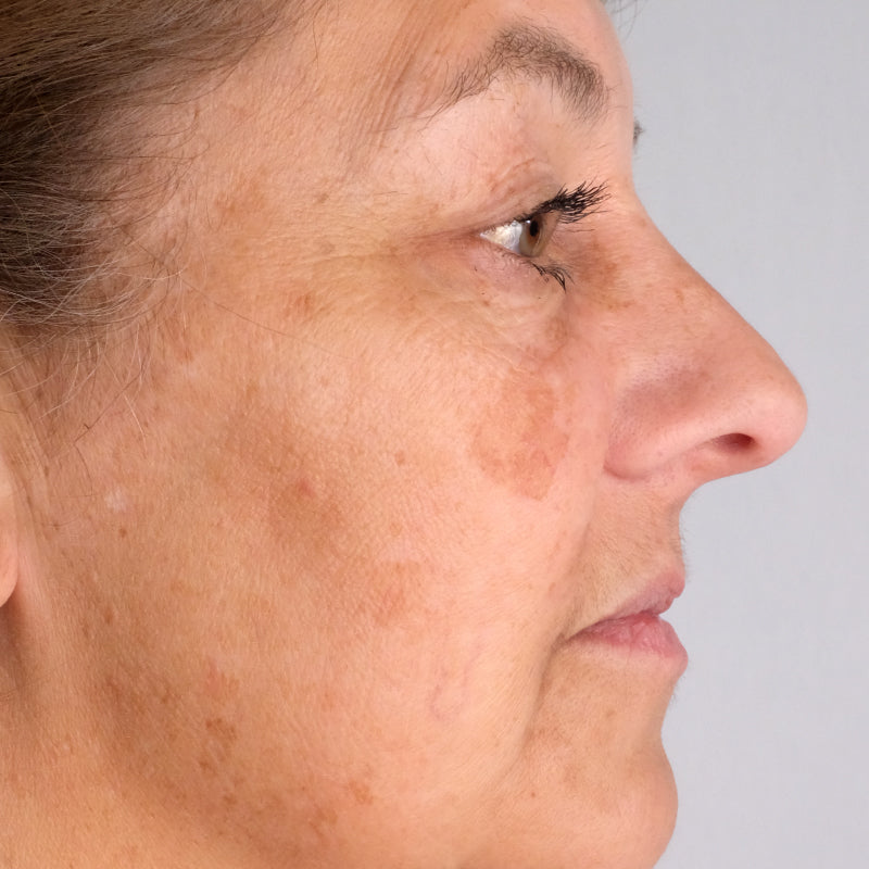 Woman age 35 - 50 who participated in Doctor Rogers Advance Duo Treatment Study displaying side profile of face before starting treatments.  