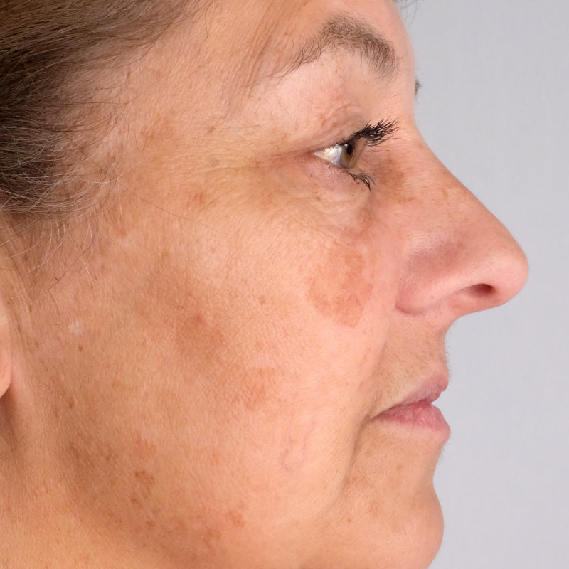 Woman age 35 - 50 who participated in Doctor Rogers Advance Duo Treatment Study displaying side profile of face before starting treatments.