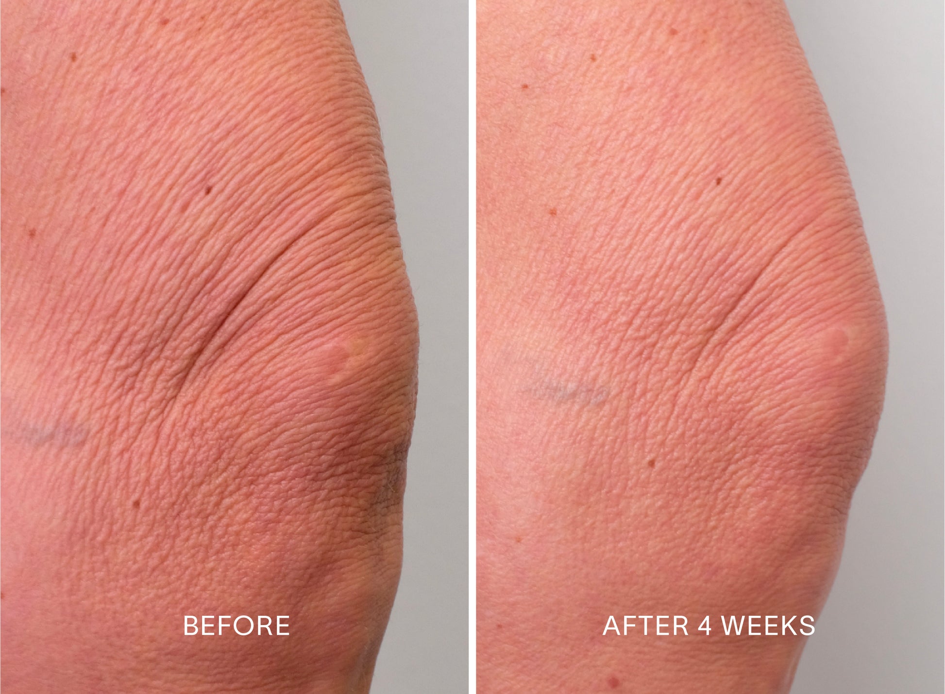 Doctor Rogers Body Duo | Featuring the Body Repair Treatment to smooth crepey skin, soften wrinkles, and even tone. Also includes Body Cream to deeply hydrate and strengthens the skin barrier using the highest-quality humectants, emollients, and ceramides.  
Picture featuring before and after results of women who used Doctor Rogers Body Duo in a 4 week clinical study with visibly less wrinkles on her legs/knee. 
Safe for men and women wtih all skin types including sensitive, mature, aging skin.