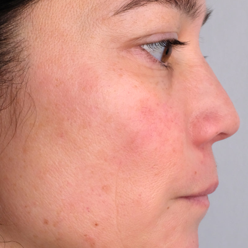Woman age 30 - 50 who participated in Doctor Rogers Advance Duo Treatment Study displaying side profile of face before starting treatments.