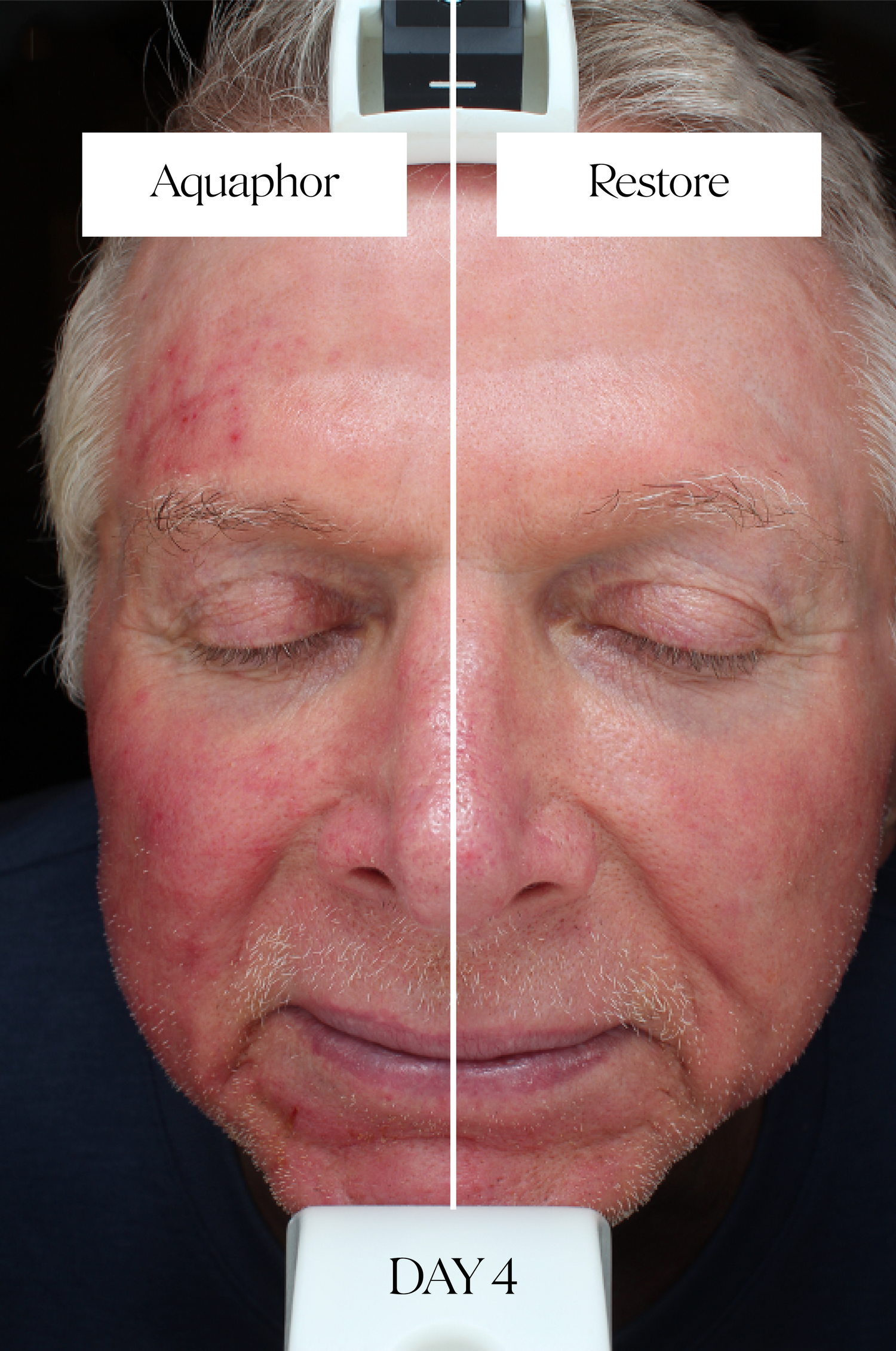Middle-aged man who participated in Doctor Rogers Restore Healing Balm clinical study using Aquaphor on left side of face and Restore Healing Balm on right side of face post-procedure