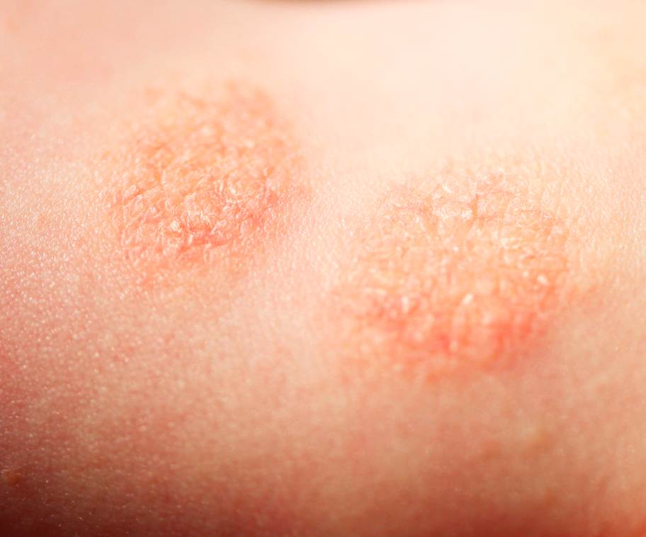 Eczema Explained: Causes and Classifications | Heather D. Rogers
