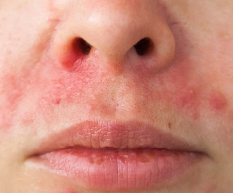 10 Winter Skin Tips From a Dermatologist