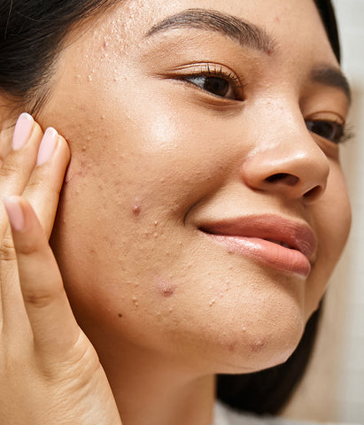 Acne & Pimples 101: Why We Break Out and How to Handle It Like a Dermatologist