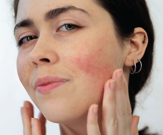 Woman with Rosacea on Face