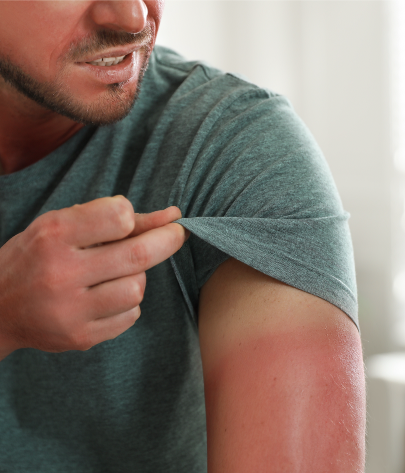 How to Treat and Prevent Sunburn: Expert Tips for Healthy Skin