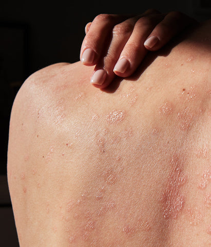 dermatologist-approved winter skincare routine for eczema