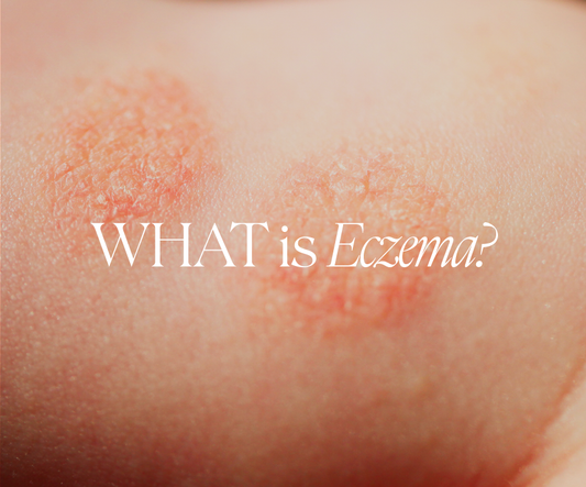 Doctor Rogers Skincare Blog: What is Eczema (Dermatitis)
