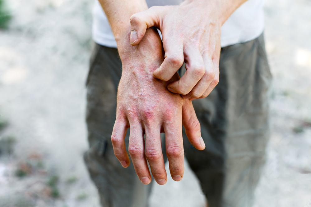 Winter Eczema and What To Do About It