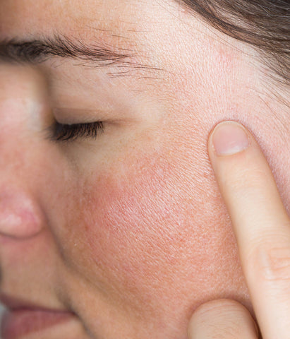 Understanding Hyperpigmentation and Dark Spots (Dermatologist Guide)