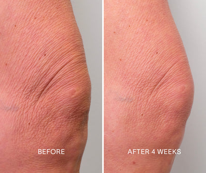 Doctor Rogers Body Repair Treatment | Best body serum designed to smooth crepey skin, restore hydration, diminish wrinkles and even skin tone. 

Picture Featuring before and after results of a 4 week clinic trial using Doctor Rogers Body Repair Treatment and Body Cream with visibly smoother skin and less wrinkles on the knee.


Safe for all skin types including men and women with mature, sensitive, acne prone skin. 