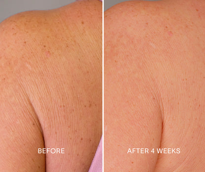 Doctor Rogers Body Repair Treatment | Best body serum designed to smooth crepey skin, restore hydration, diminish wrinkles and even skin tone. 

Picture Featuring before and after results of a 4 week clinic trial using Doctor Rogers Body Repair Treatment and Body Cream with visible less wrinkles and dark spots on shoulder. 

Safe for all skin types including men and women with mature, sensitive, acne prone skin. 