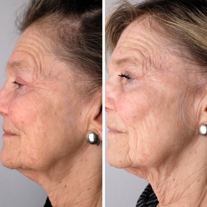 Before and After Picture of woman with mature skin who used Doctor Rogers Daytime Preventive Serum to slow aging by protecting skin against sun damage and Doctor Rogers Night Repair Treatment Serum to reduce wrinkles, smooth fine lines and renew aging skin.
