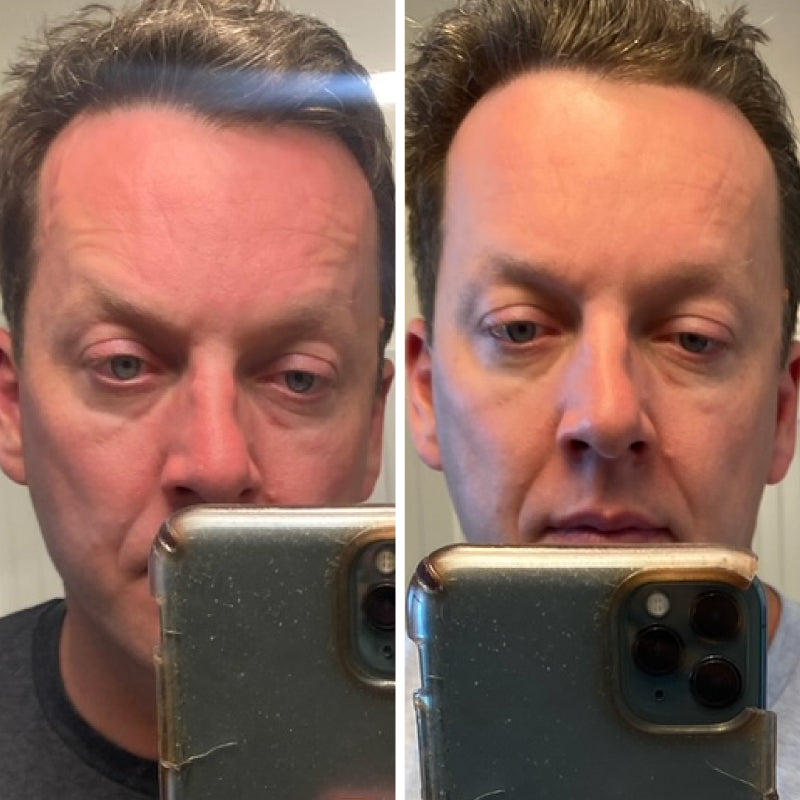 Middle aged man before (left) and after (right) photos using Doctor Rogers Day Preventive Treatment Serum to quickly heal sunburn on face