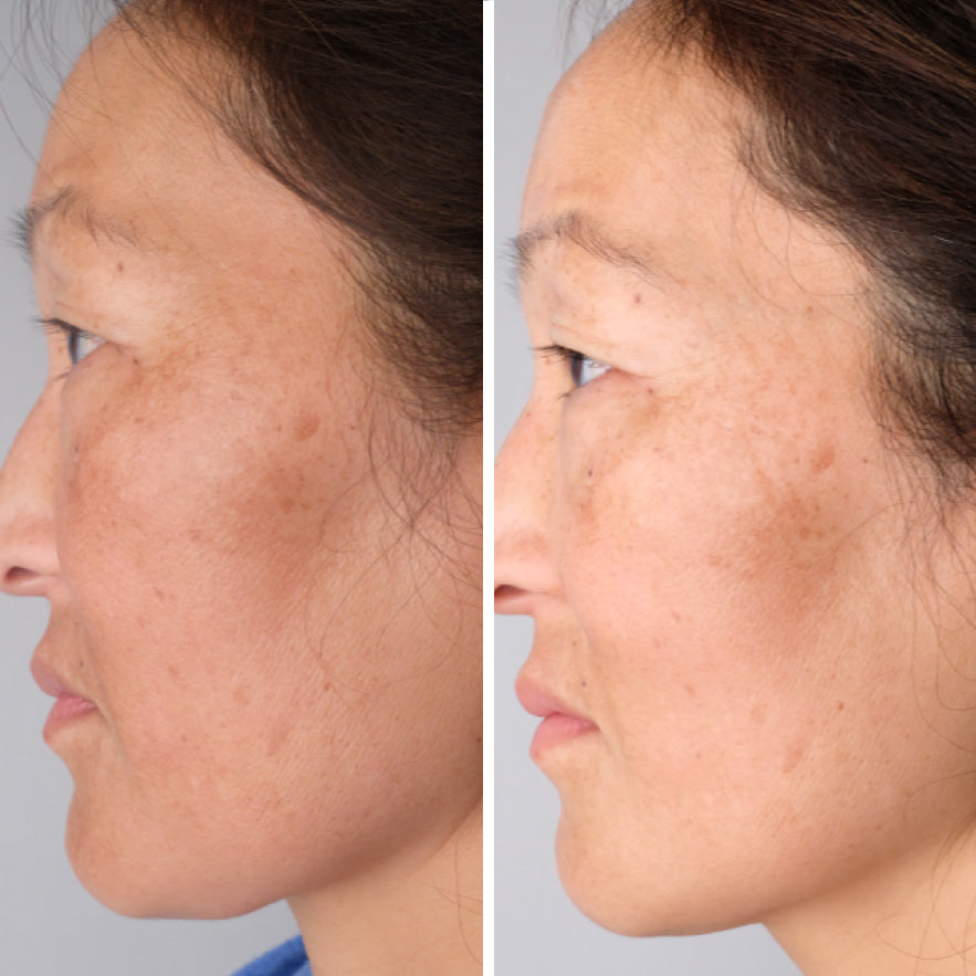 Before and After Picture of middle-aged woman who used Doctor Rogers Daytime Preventive Serum to slow aging by protecting skin against sun damage and Doctor Rogers Night Repair Treatment Serum to reduce wrinkles, smooth fine lines and even skin tone