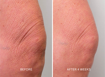 Doctor Rogers Body Duo | Featuring the Body Repair Treatment to smooth crepey skin, soften wrinkles, and even tone. Also includes Body Cream to deeply hydrate and strengthens the skin barrier using the highest-quality humectants, emollients, and ceramides.  

Picture featuring before and after results of women who used Doctor Rogers Body Duo in a 4 week clinical study with visibly less wrinkles on her legs/knee. 

Safe for men and women wtih all skin types including sensitive, mature, aging skin.