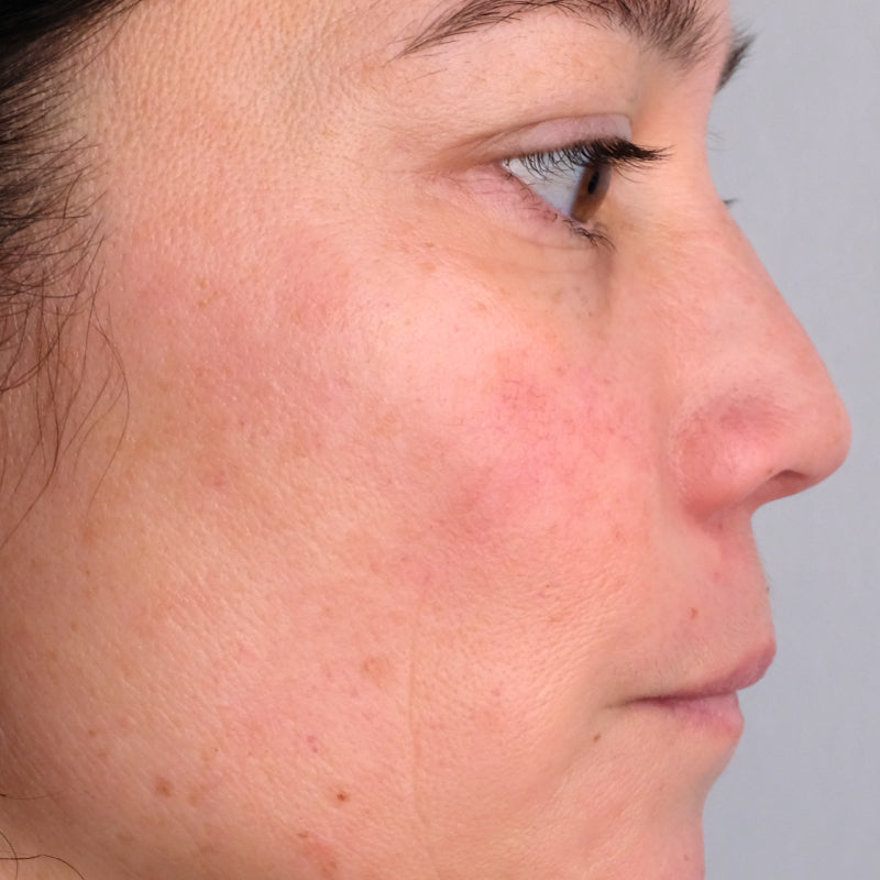 Woman age 30 - 50 who participated in Doctor Rogers Advance Duo Treatment Study displaying side profile of face before starting treatments.  