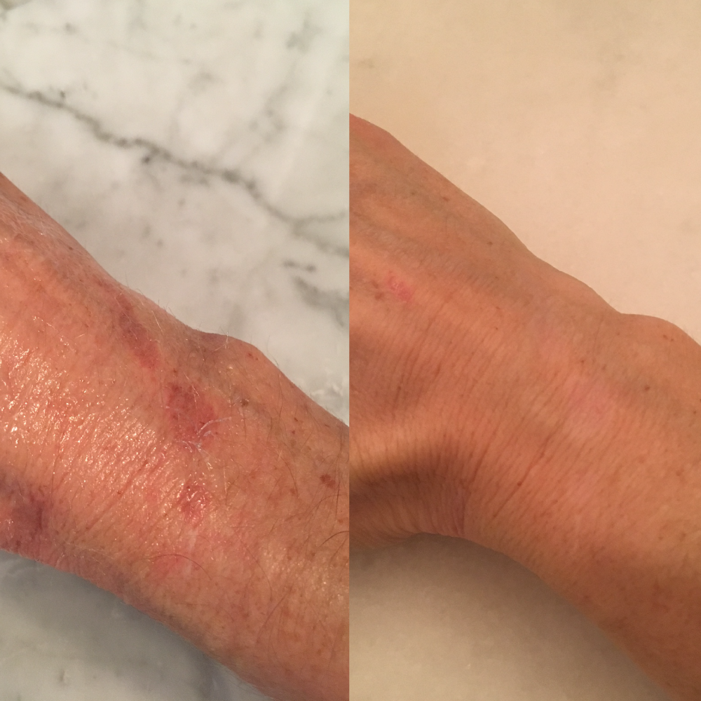 Before (left) and After (right) picture of person who burned wrist and applied Doctor Rogers Restore Healing Balm to heal damaged, burned skin, reduce redness, and minimize scarring