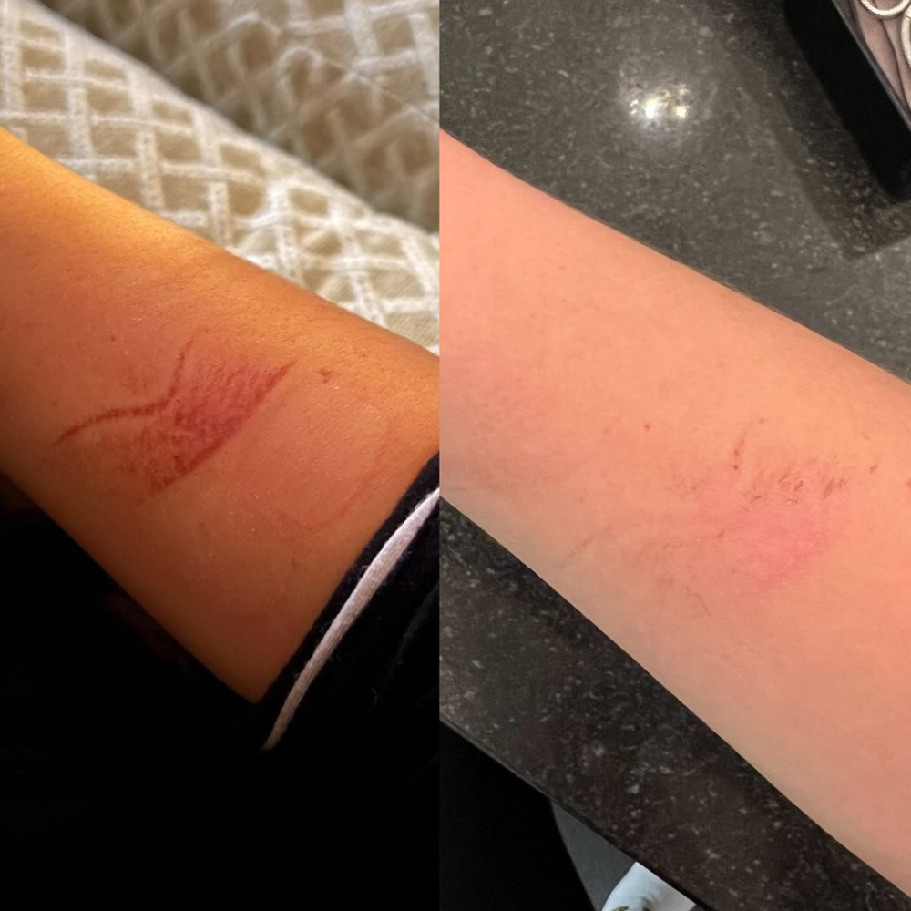 Before (left) and After (right) picture of person who burned arm and applied Doctor Rogers Restore Healing Balm to heal damaged, burned skin, reduce redness, and minimize scarring