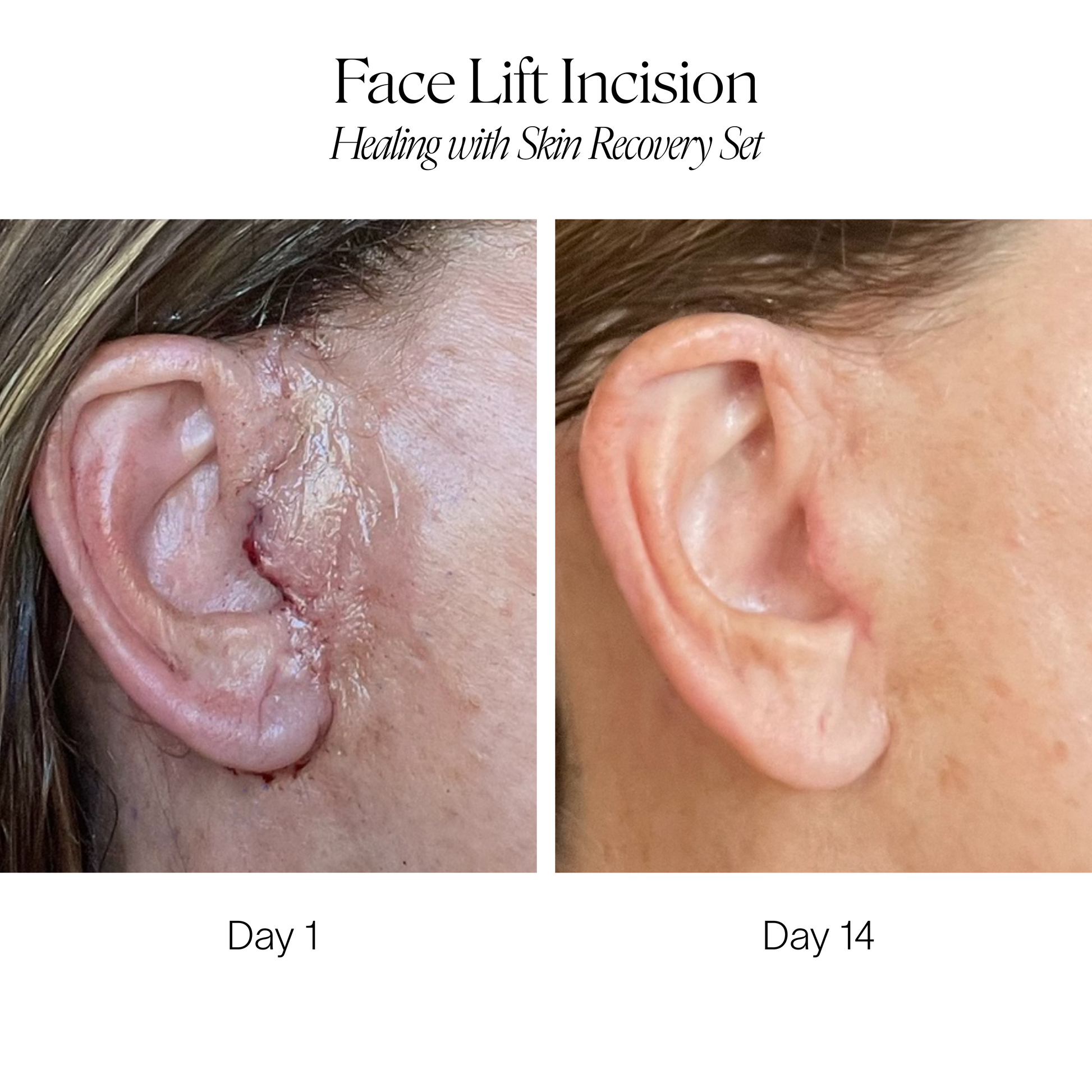 Before and after comparison of a face lift incision healing process on Day 1 and Day 14 after using Doctor Rogers Skin Recovery Set