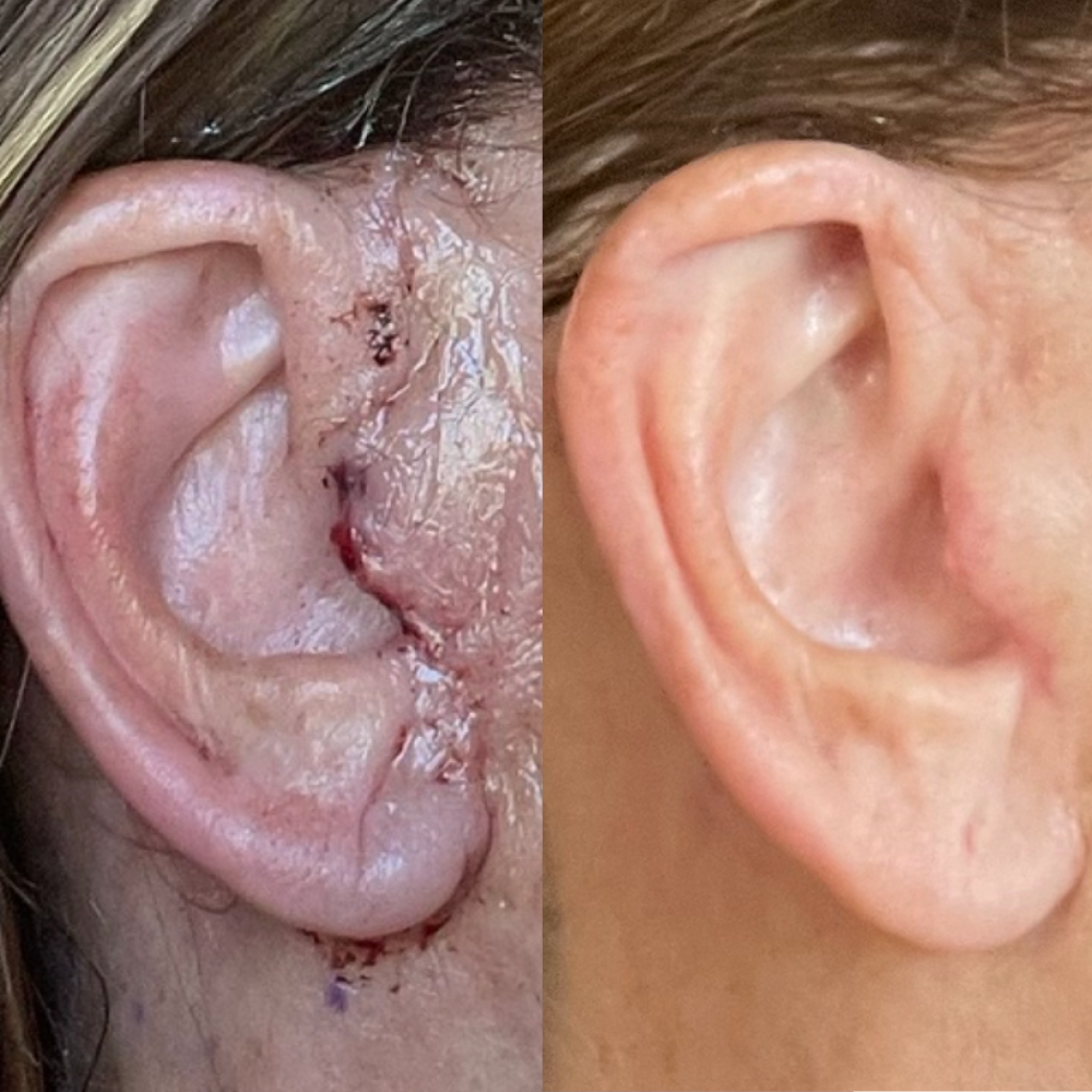 Before (right) and after (left) pictures of woman who used Doctor Rogers Restore Healing Balm | For Eczema, Injured and Irritated Skin made with glycerin and castor oil to quickly heal scarring (including post-procedure) and outperform Aquaphor