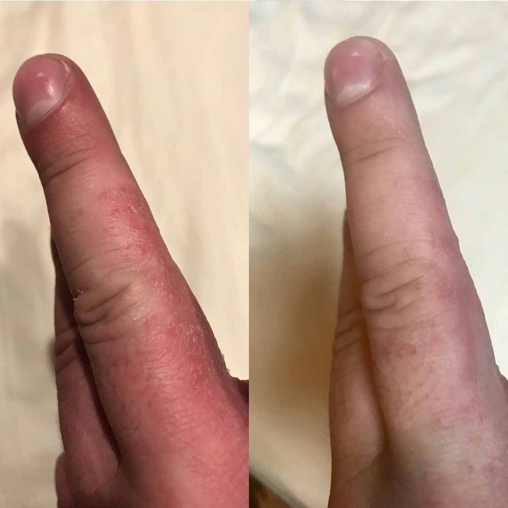 Before (left) and After (right) picture of person with severe eczema (dermatitis) on fingers/hands and applied Doctor Rogers Restore Healing Balm | Dermatologist-created Best Eczema treatment to soothe and heal dry, flaky, irritated skin 