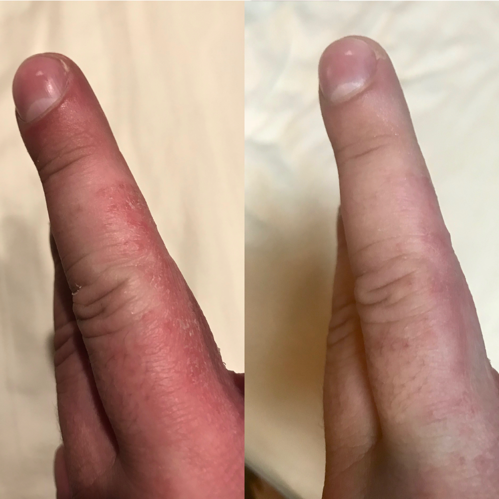 Before (left) and After (right) picture of person with severe eczema (dermatitis) on fingers/hands and applied Doctor Rogers Restore Healing Balm | Dermatologist-created Best Eczema treatment to soothe and heal dry, flaky, irritated skin