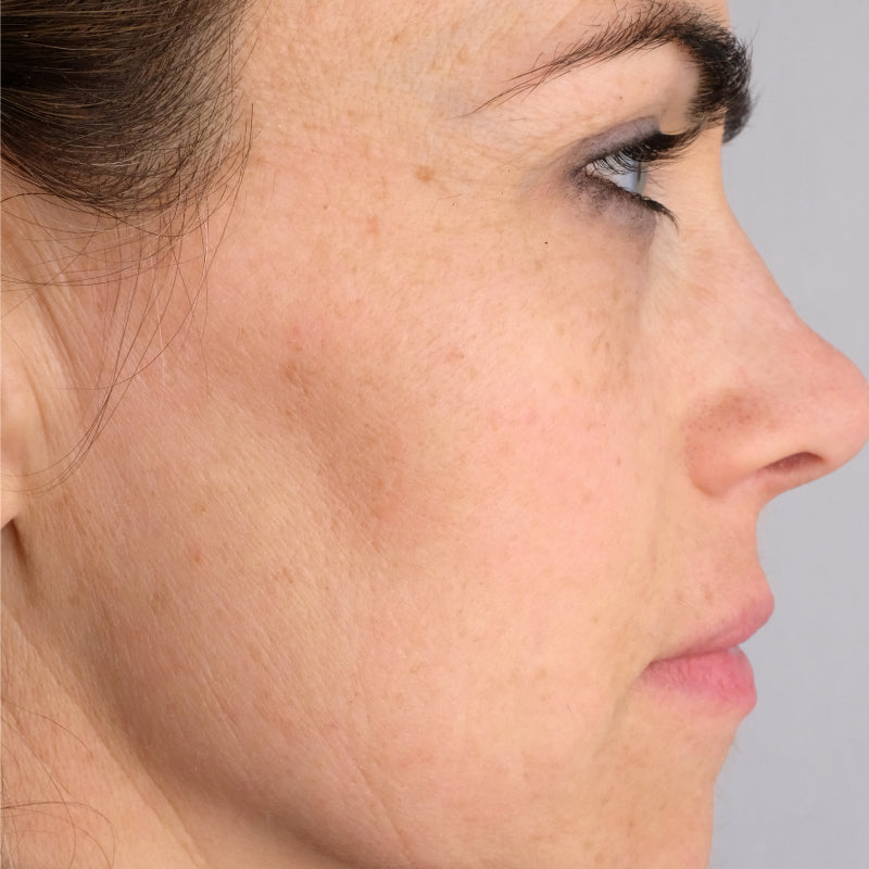 Woman age 30 - 50 who participated in Doctor Rogers Advance Duo Treatment Study displaying side profile of face before starting treatments 