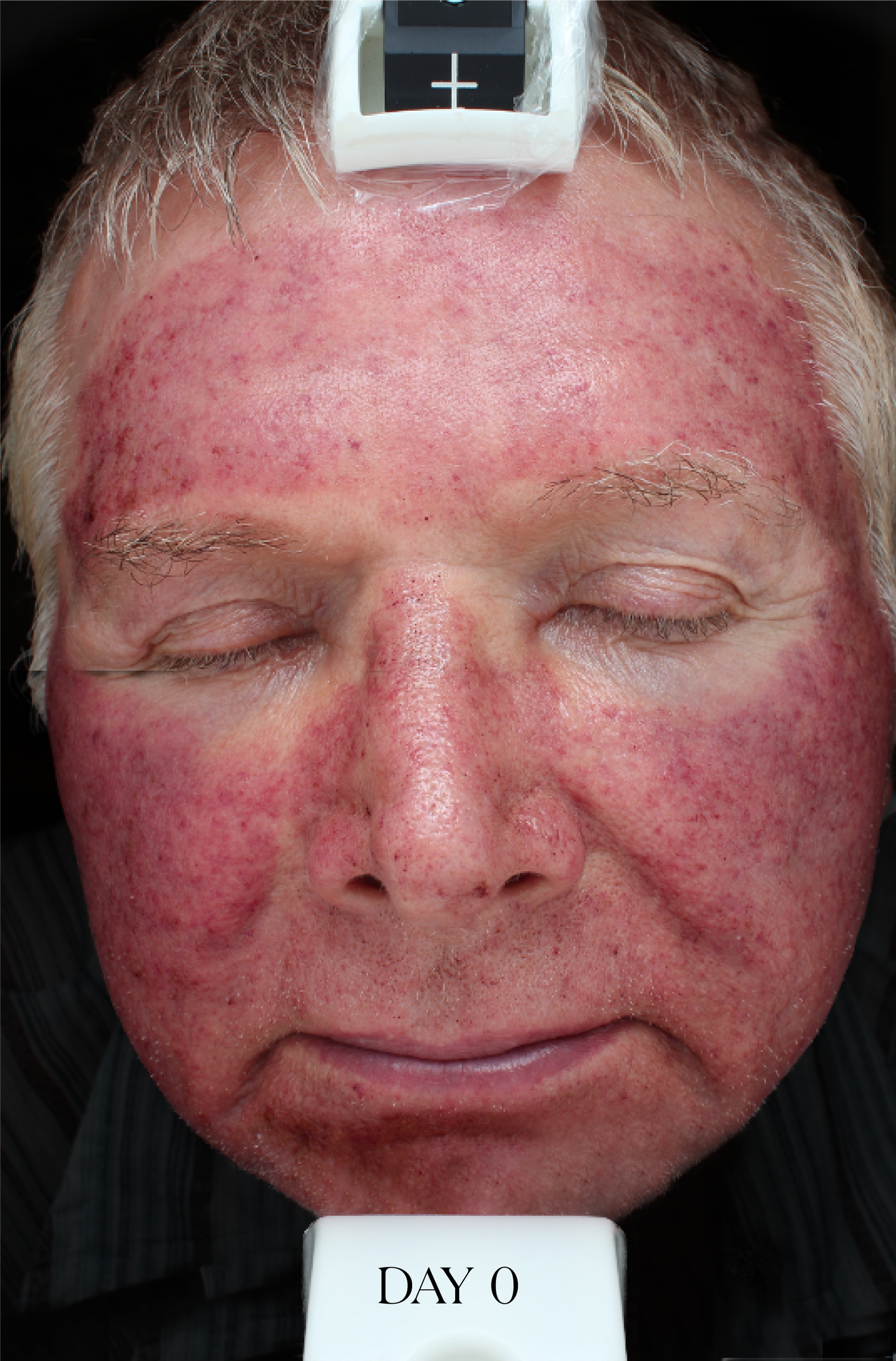 Middle-aged man displaying red, irritated, sensitive post-procedure skin who participated in Doctor Rogers Restore Healing Balm clinical study 